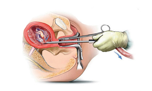 Прерывании беременности в случае диагностирования аномалий развития плода